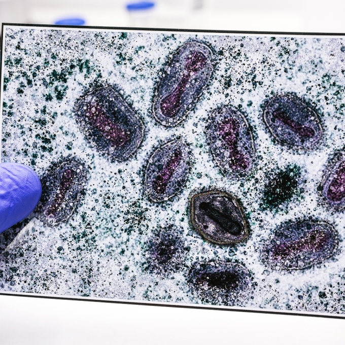 Monkeypox-Getty