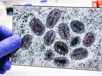 Monkeypox-Getty